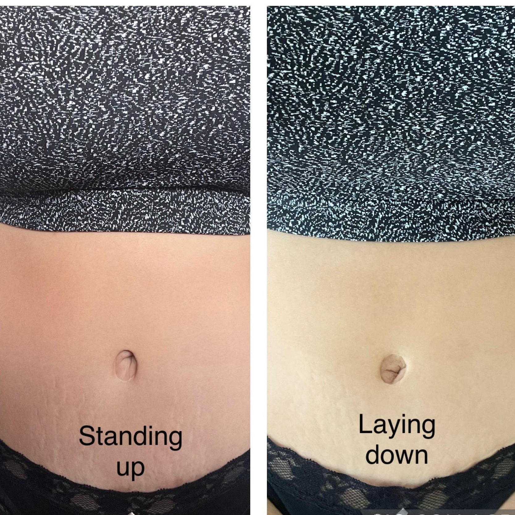 Belly Button Piercing After Tummy Tuck