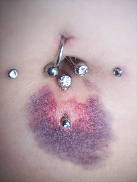 Bruising After a Piercing: Is It Normal?