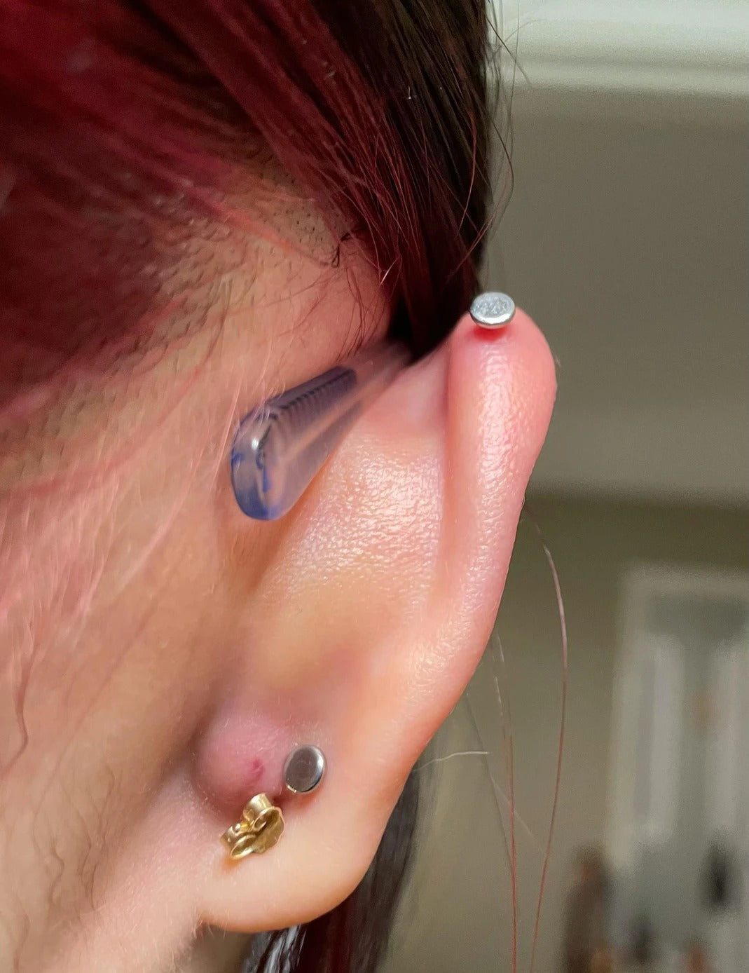 Moisture Irritation Bumps on Earlobe Piercings