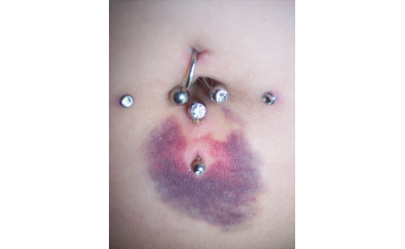 Bruising After a Piercing: Is It Normal?