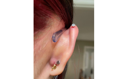 Moisture Irritation Bumps on Earlobe Piercings