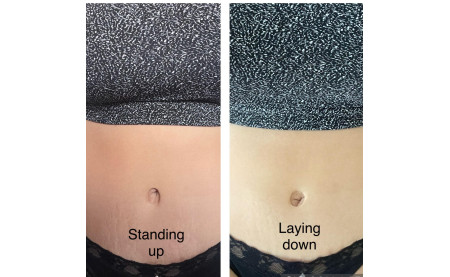 Belly Button Piercing After Tummy Tuck
