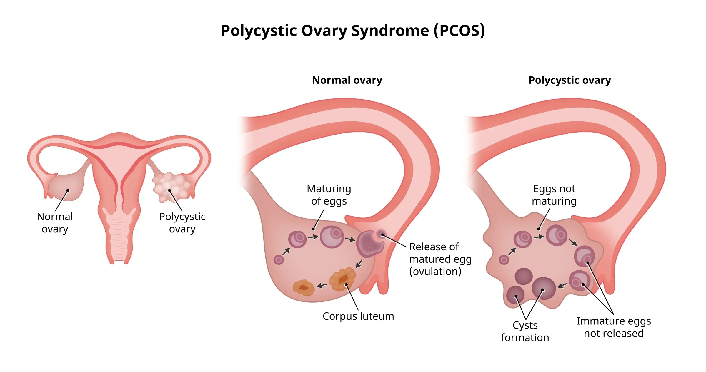 PCOS Ovary