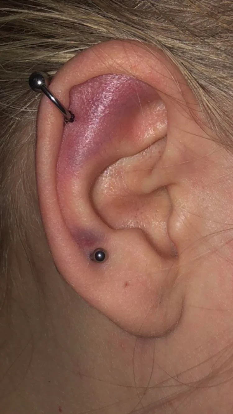 Bruising Happen After a Piercing